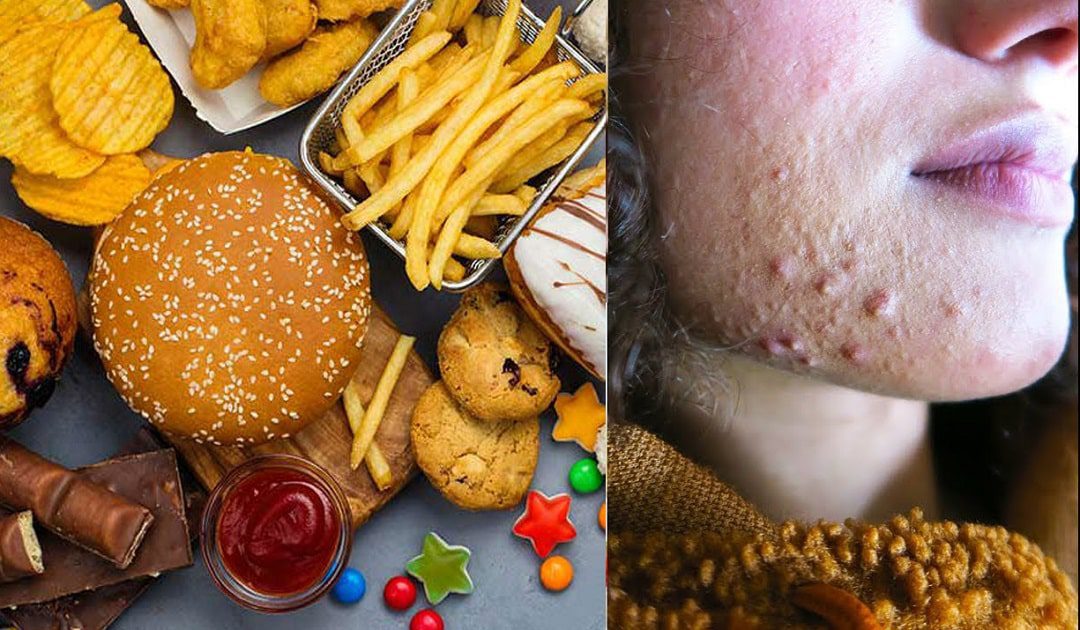 چه غذاهایی باعث جوش صورت میشوند؟ معرفی خوراکیهای جوشزا 2 معرفی غذاهای جوش زا