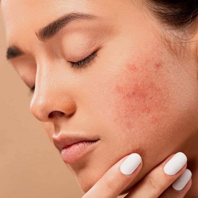 چه غذاهایی باعث جوش صورت میشوند؟ معرفی خوراکیهای جوشزا 1 چه غذاهایی باعث جوش صورت میشوند